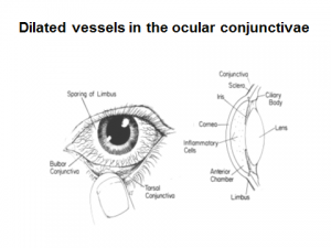 Validering Hængsel Som regel Ask the KD Experts: KD & Vision Loss | Kawasaki Disease Foundation