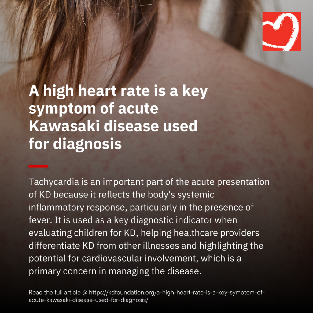 A high heart rate is a key symptom of acute Kawasaki disease used for diagnosis